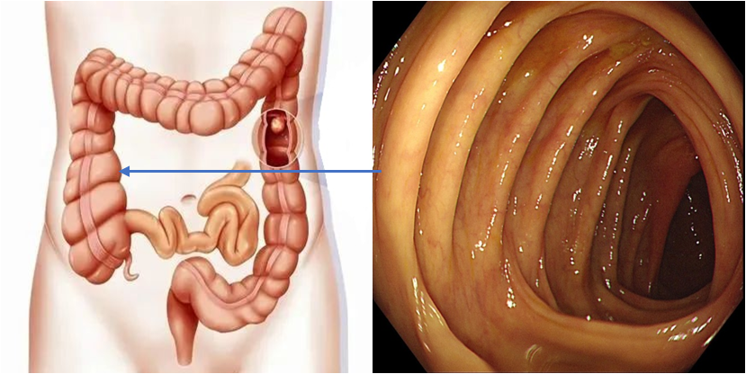 到达了结肠肝曲,特征性的表现是该位置可以看到肠壁后面的青色区域