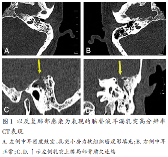 行乳突高分辨率ct三維成像(圖1)考慮左側慢性硬化性中耳乳突炎,不能除