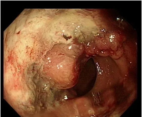 一个被"痔疮"谋害的生命:46岁,半年去世!