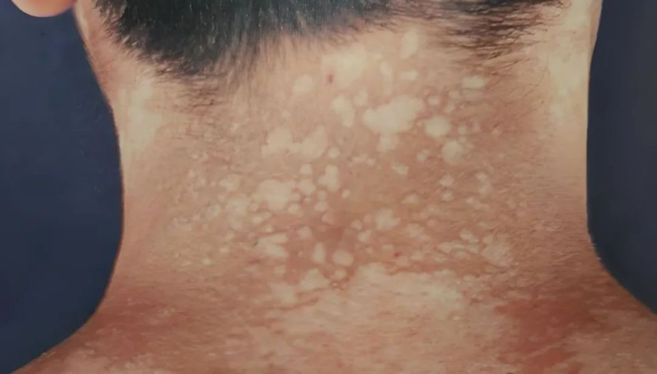 为什么健身后身体会出现汗斑