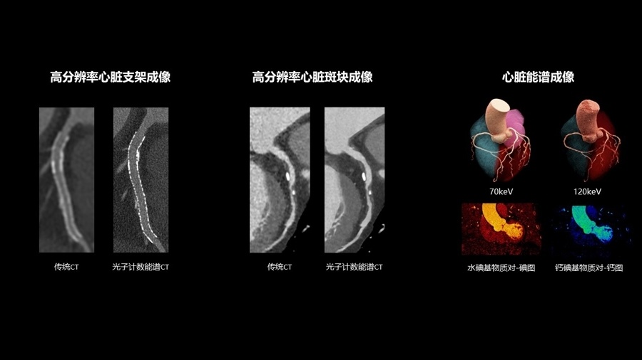 重要突破！联影光子计数能谱CT进入中山和瑞金医院开启临床测试_腾讯新闻