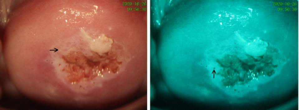 碘染呈芥末黄图 4:宫颈高级别病变下醋白上皮增厚,污浊,性状不规则