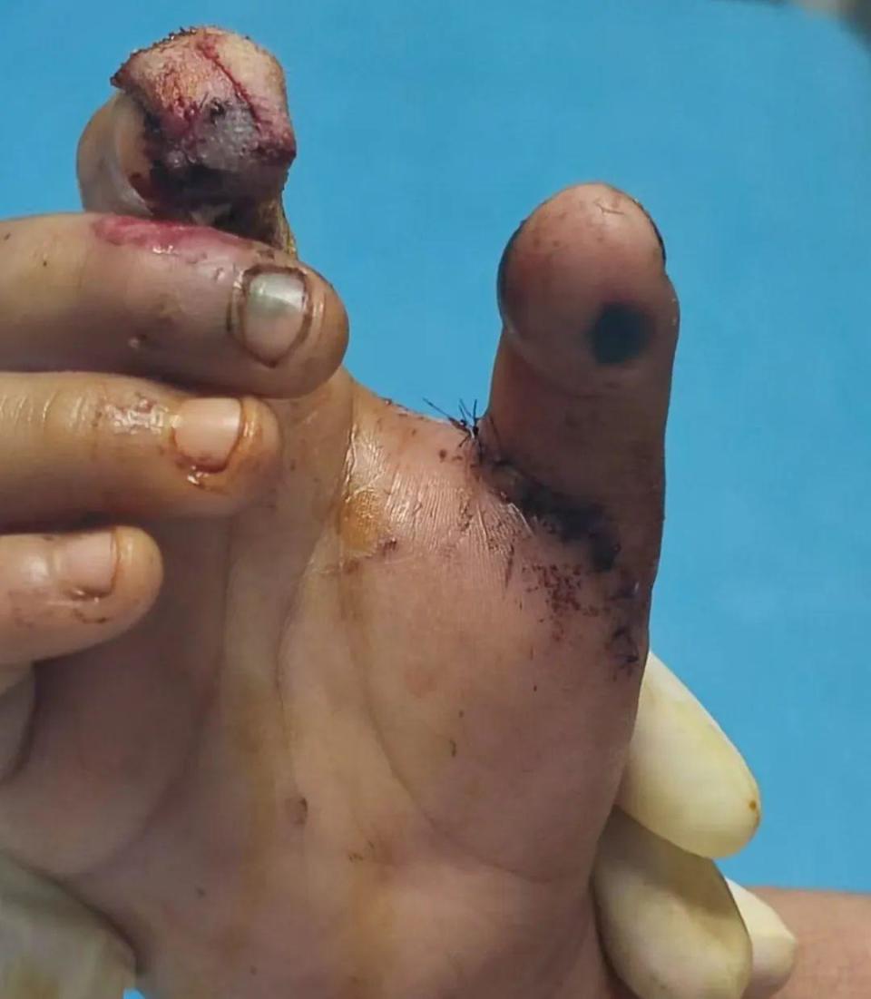 孩子手指被炸伤,看着都疼!