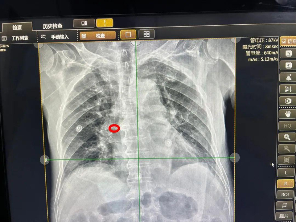 picc置管胸片正确位置图片