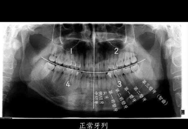 24岁小伙拔牙后晕倒，开颅手术后去世，智齿还能拔吗？图3