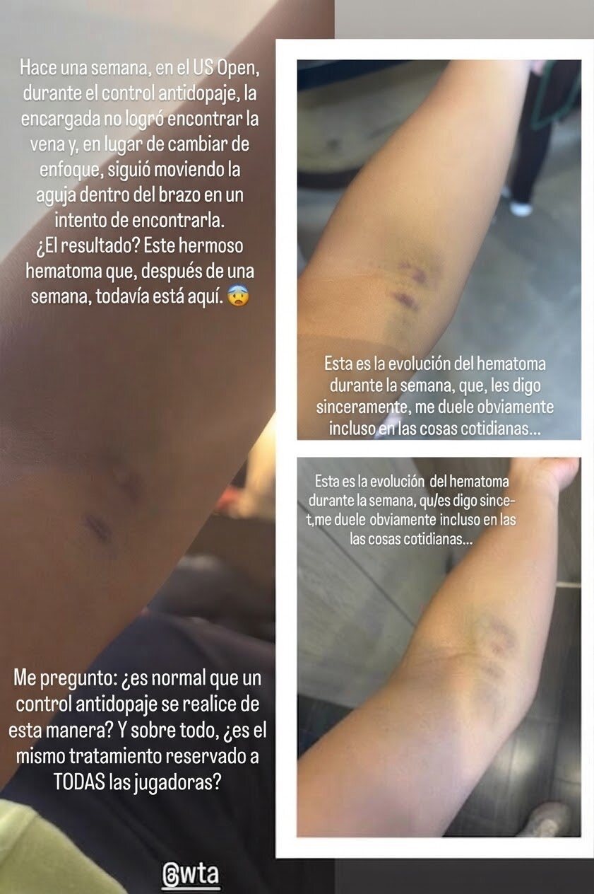 美网兴奋剂检测人员找不到血管 致球员手臂淤伤退赛