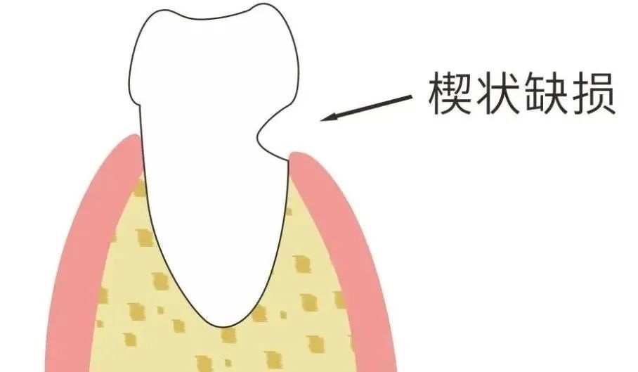 楔状缺损画图图片