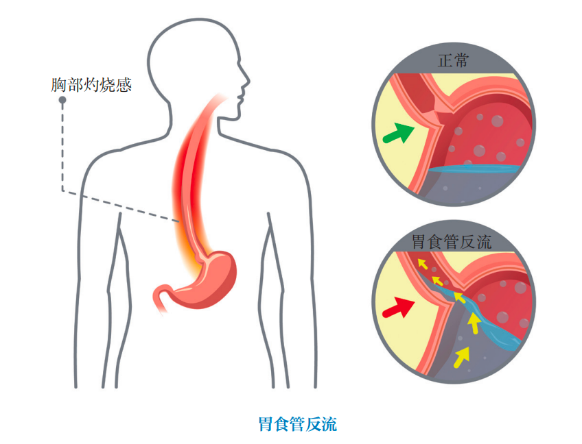 食道癌的位置图片大全图片