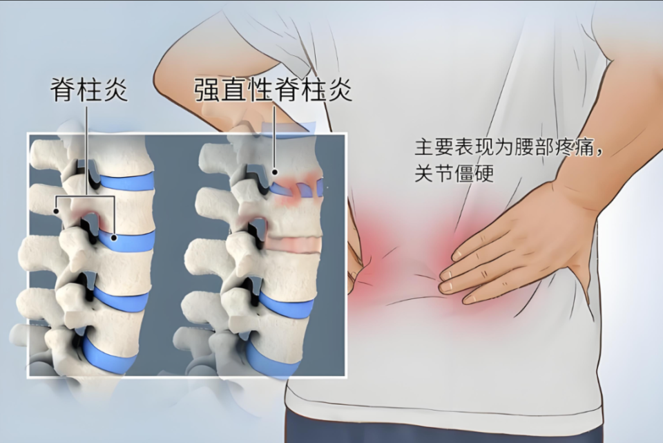 强直性脊柱炎位置图片