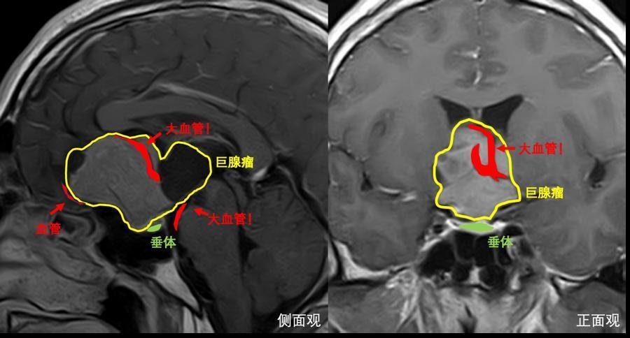 蝶窦 垂体瘤图片