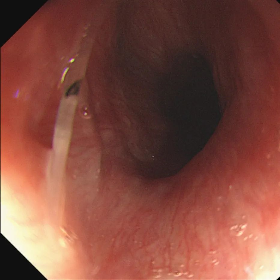 大口吞饭不可取,无痛胃镜巧取鱼刺