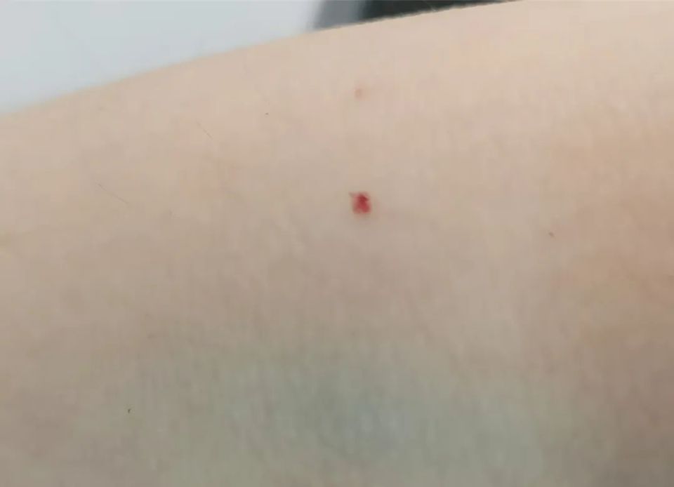 需要担心健康问题吗?为什么长红痣?