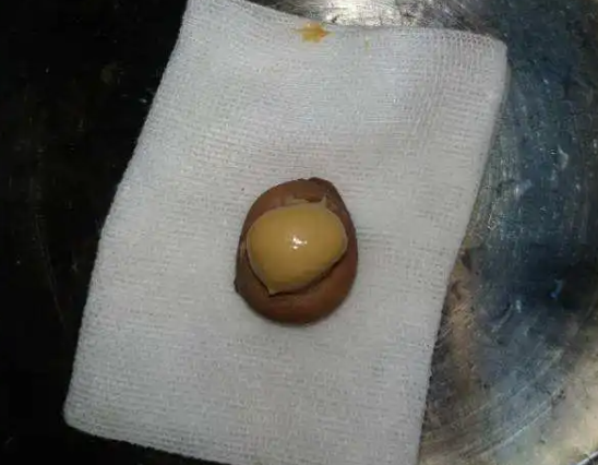 提醒:3种常见的囊肿不用担心