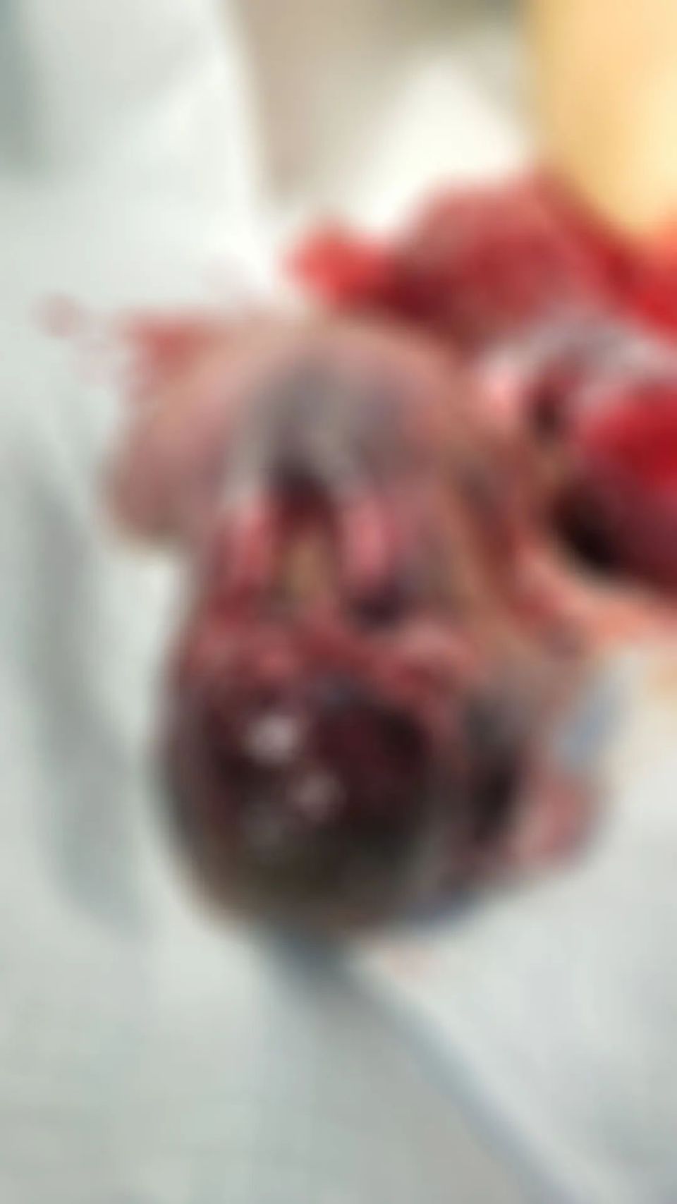 无脑儿   脊柱裂,本以为只能在教科书上才看到