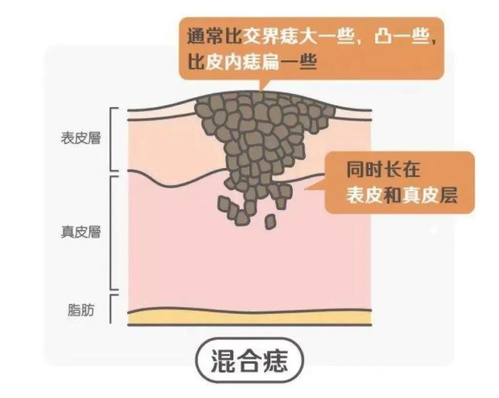 臨床上看起來和皮內痣沒有大的區分.