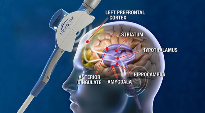 全球唯一,经颅磁刺激系统获批用于强迫症-腾讯新闻
