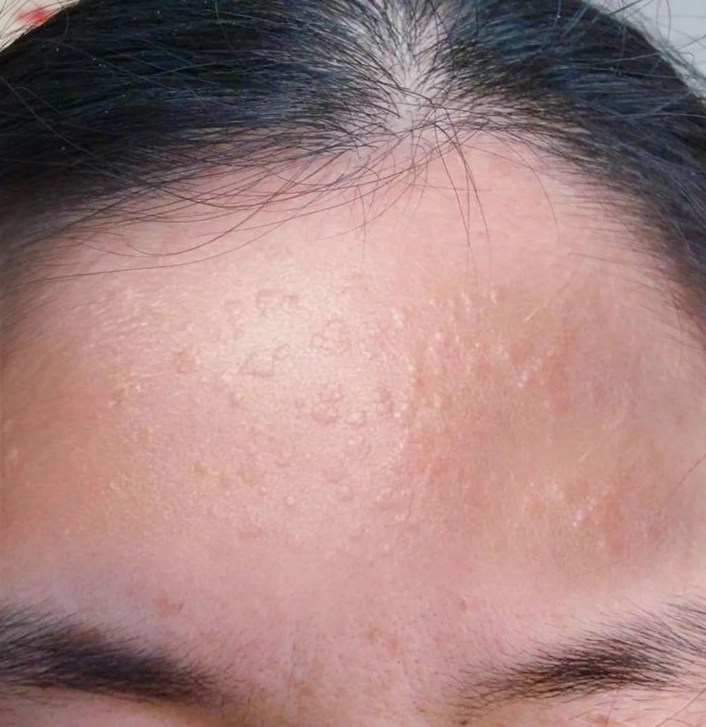 体内有病,皮肤先知!身上长了这5种小肉瘤,可能是感染了hpv_腾讯新闻