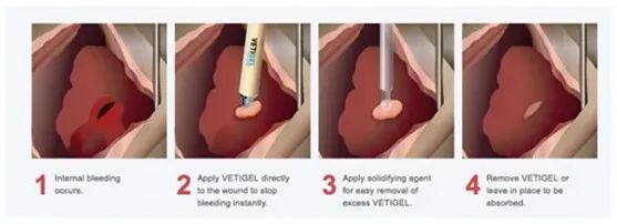 创伤胶有哪些10秒内瞬息止血！外伤“大出血”救命凝胶获批_https://www.jmylbn.com_新闻资讯_第5张