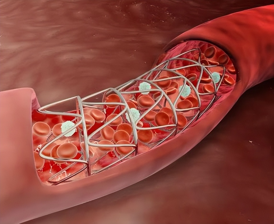 心脏血管支架图片大全图片