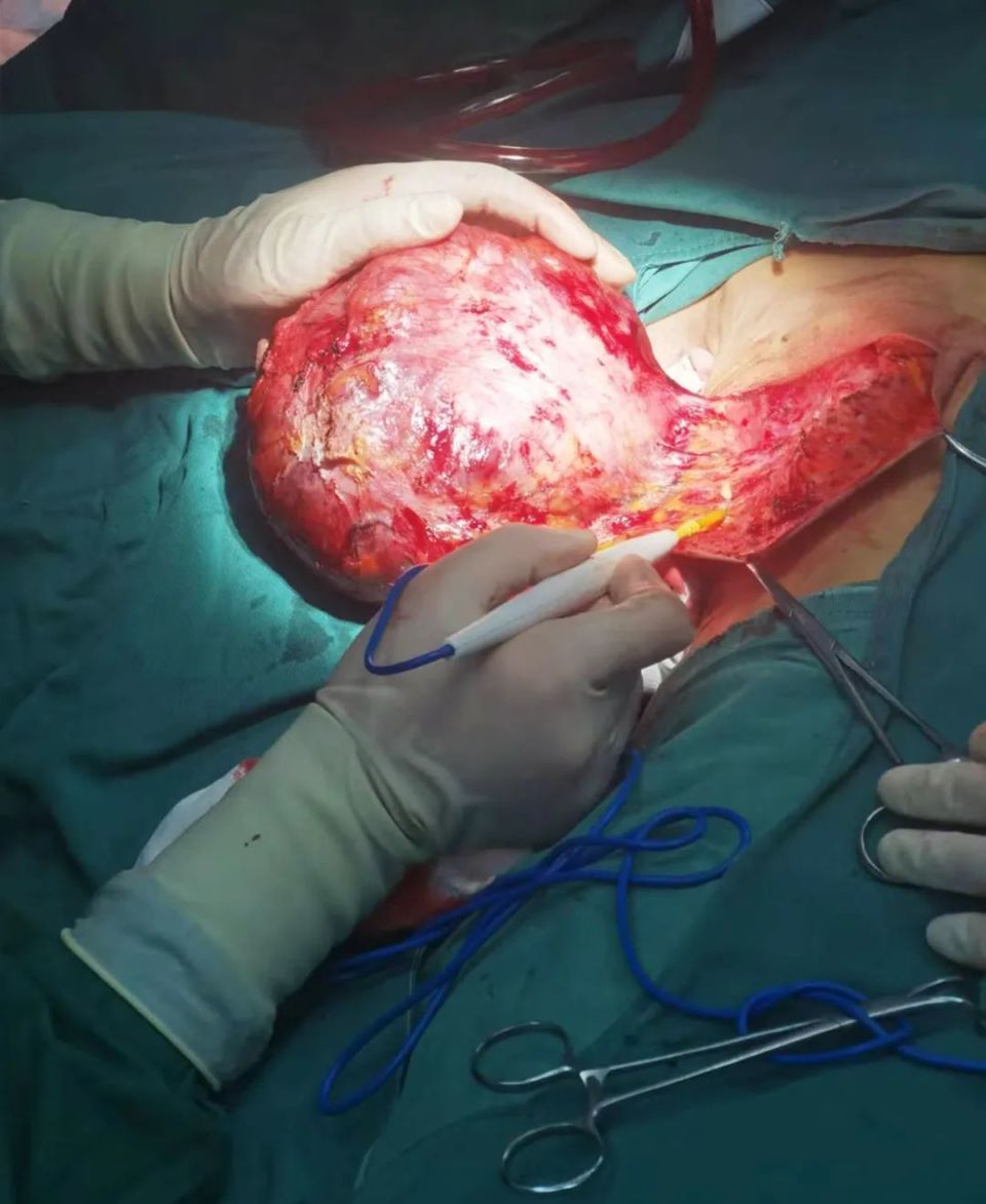 七旬奶奶乳房长了鸵鸟蛋大小肿物,武夷山市立医院乳腺外科专家手术