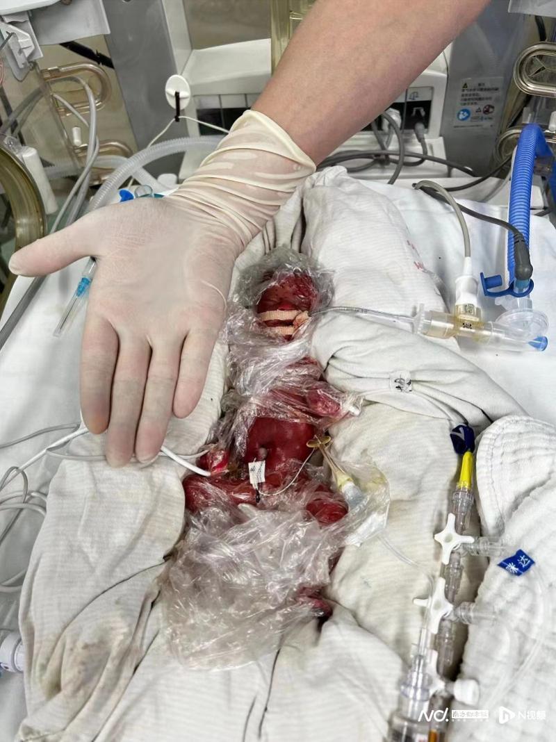 慢性高血压妈妈高危妊娠 24周早产宝宝168天救治后出院-腾讯新闻