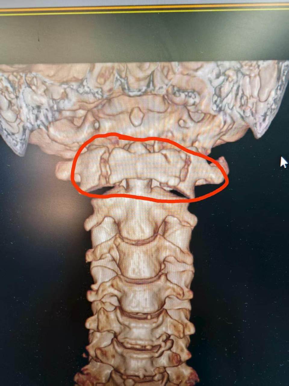广东阿姨摔成"寰椎爆裂性骨折!