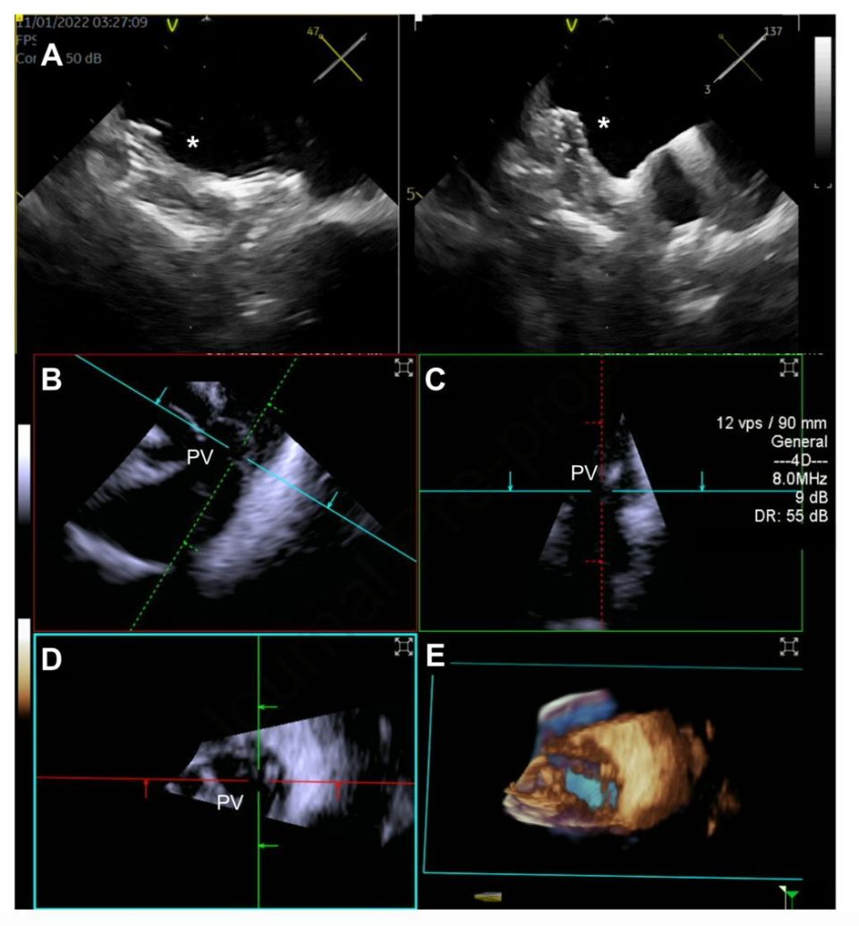 3D ICE辅助结构心-腾讯新闻