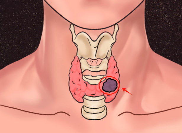 呵护颈前小蝴蝶一文教你正确认识甲状腺结节