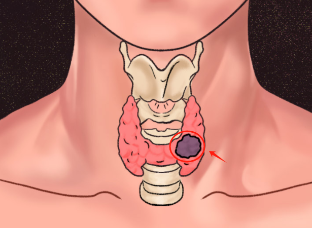 甲状腺瘤的位置图片图片