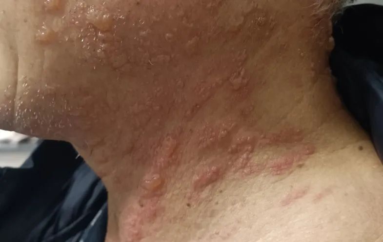 "带状疱疹和水痘其实是因同一种病毒感染而产生的不同病症.