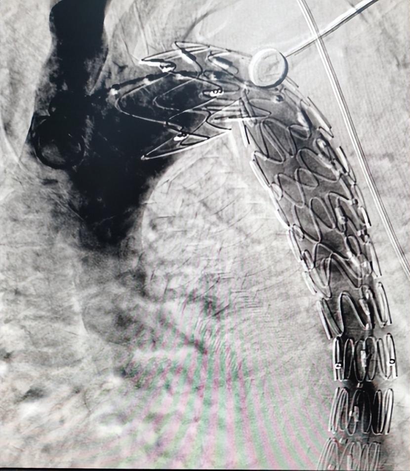 老人突发致命主动脉夹层,专家团队精准定位成功"拆弹"!