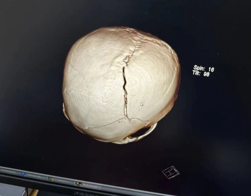 头部着地后当场昏迷突然侧翻车辆行驶至剑河县清江路大巫沟路口附近处