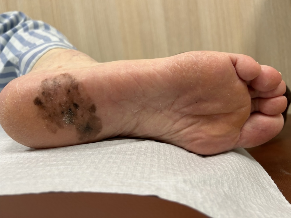 好声音亚军张恒远因黑色素瘤离去不少年轻人慌忙赶去皮肤科快帮我排查