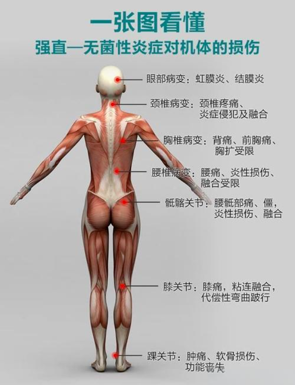 强直性脊柱炎,治疗误区导致病情加重,避开这些陷阱