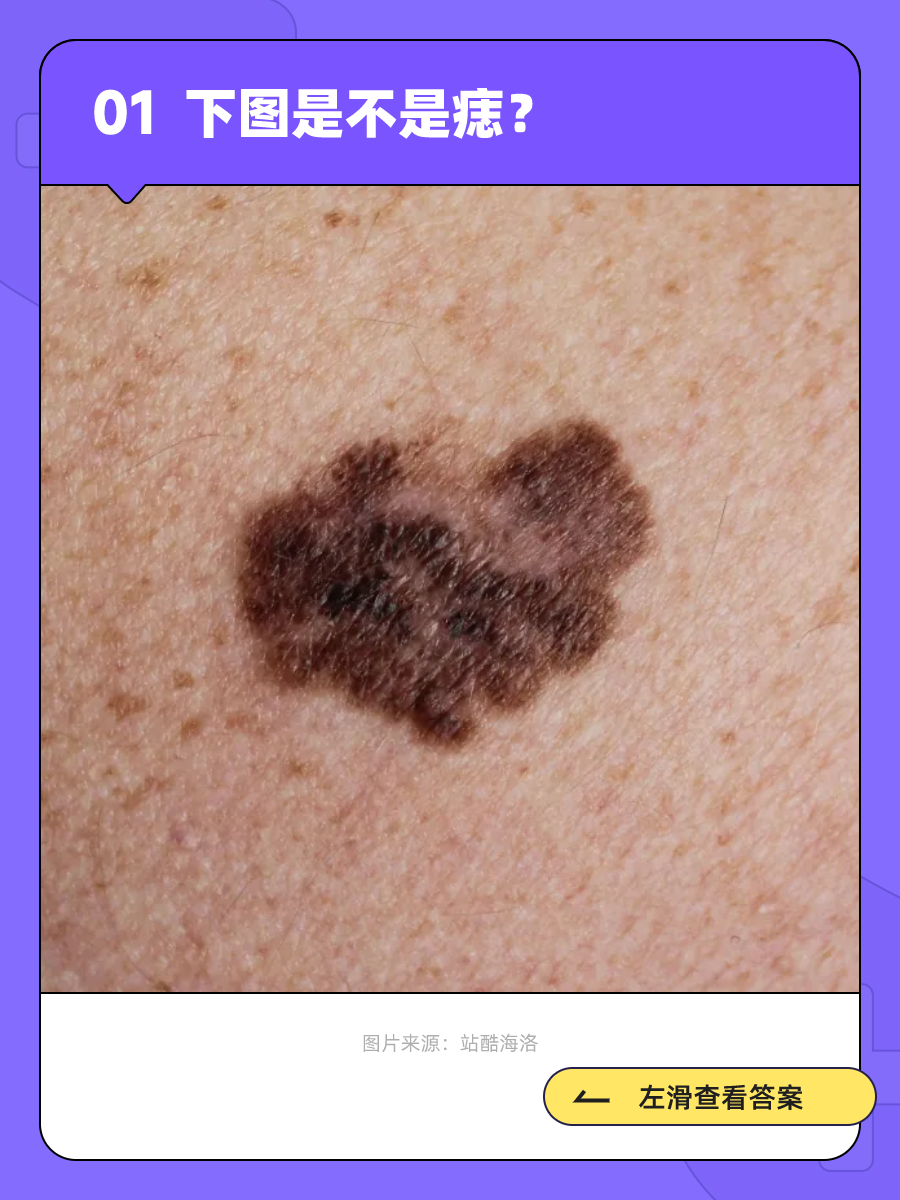 身上的小黑点不一定都是痣,有一种竟会癌变!