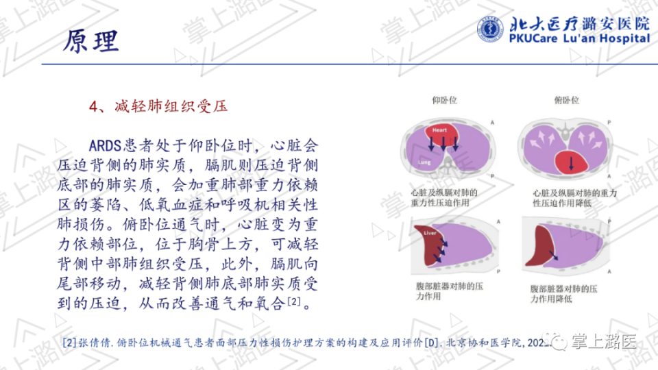 【ppt】俯卧位通气的护理