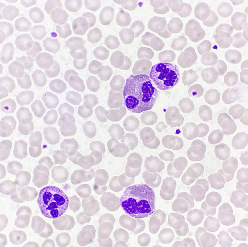 嗜酸性粒细胞增高你遇到这种疾病么