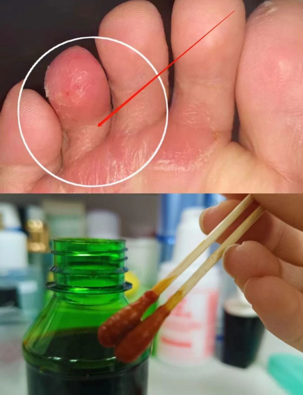 脚底瘙痒长泡终于根除了!过来人3个康复秘诀曝光,一天几毛钱!