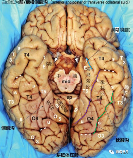 颞叶钩回解剖位置图片