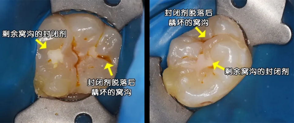 想要窝沟封闭效果更好,得注意这几点!