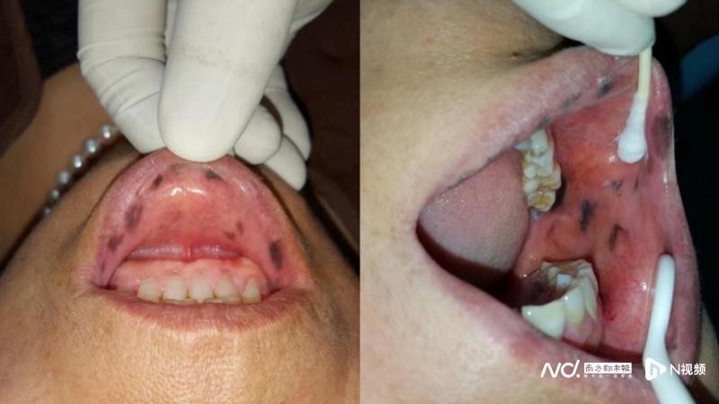 知名歌手因黑色素瘤去世!口腔黏膜长黑斑要小心癌变