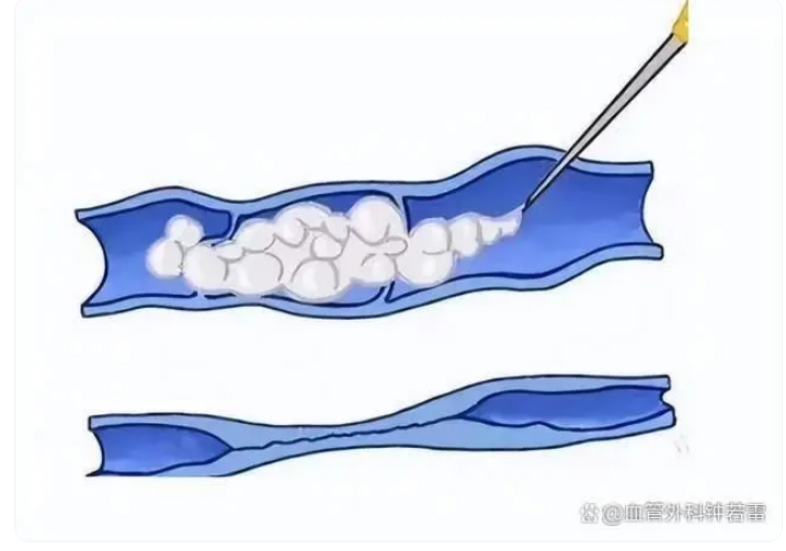 有治疗静脉曲张最好的方法吗?你关心的问题都在这!_腾讯新闻