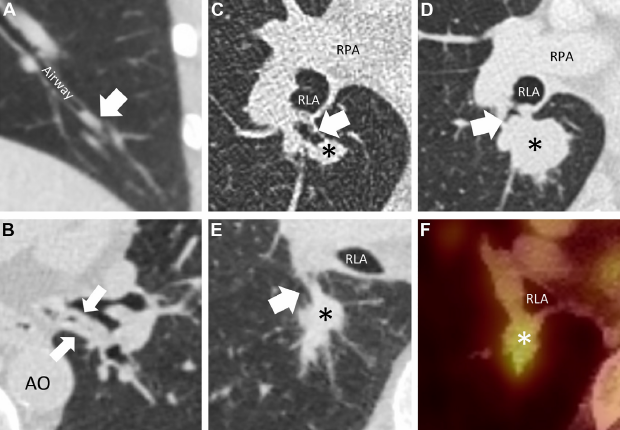 充分利用 Lung-RADS，做好肺结节筛查与应对_腾讯新闻
