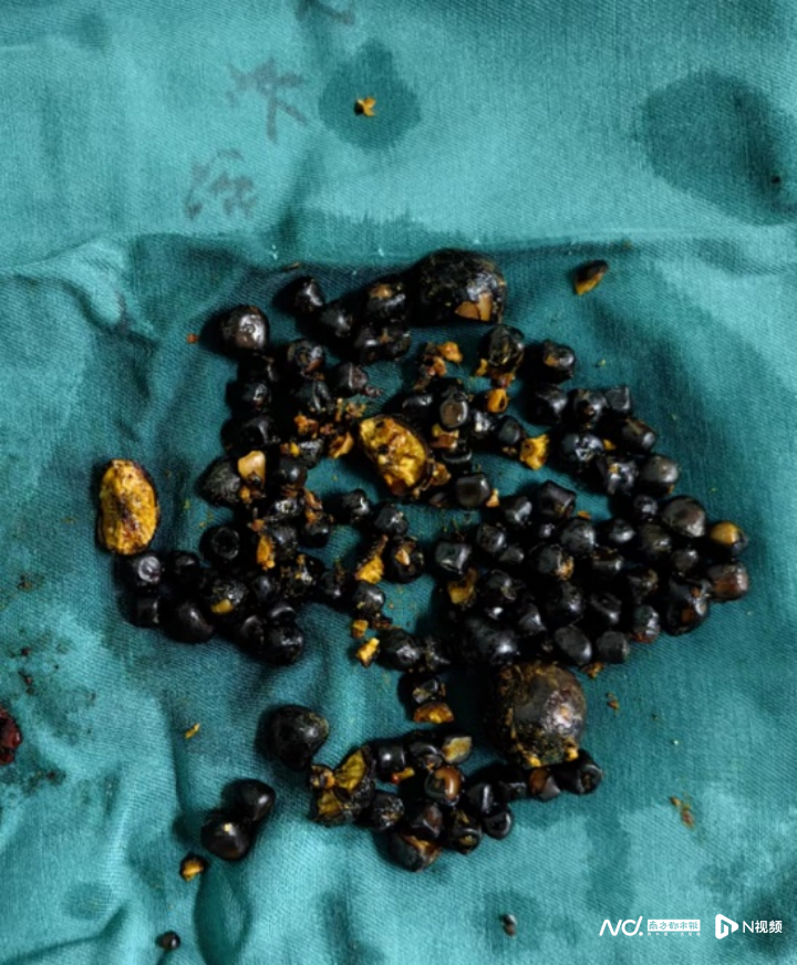 女子胆囊里掏出114颗结石!专家:春节尤需警惕急性胆囊炎