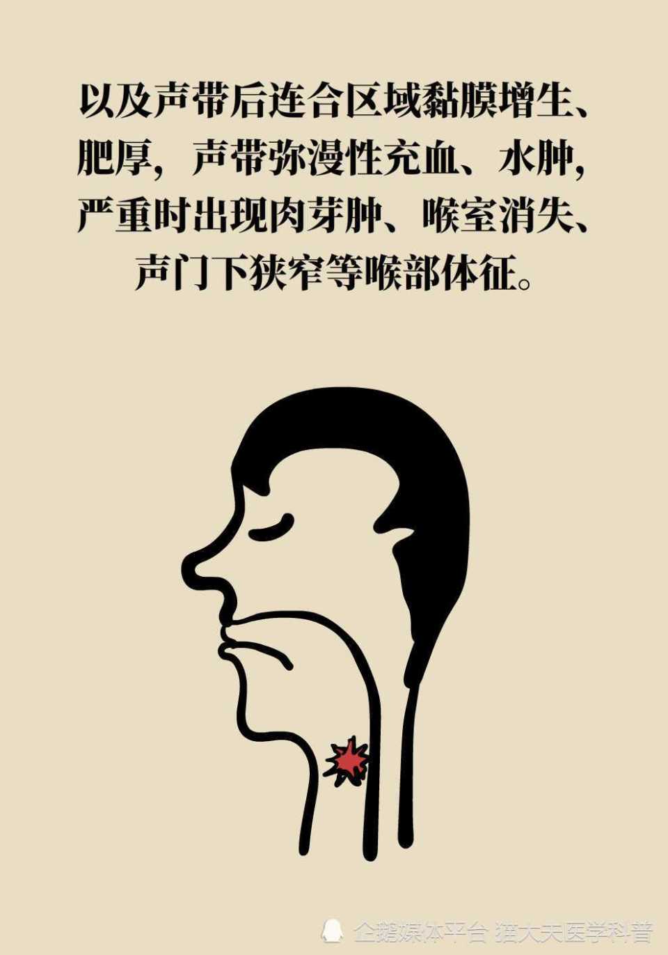 慢性咽喉炎久治不愈, 竟是因为"跨界"成反流性咽喉炎了?