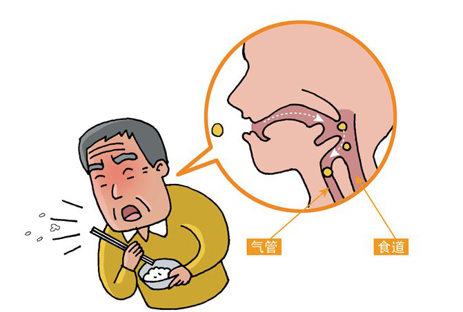 揭秘吞咽障碍:认识,预防与康复