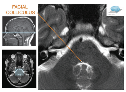 colliculus syndrome,轴位t2加权(a),dwi(b)可见左侧面丘处信号改变