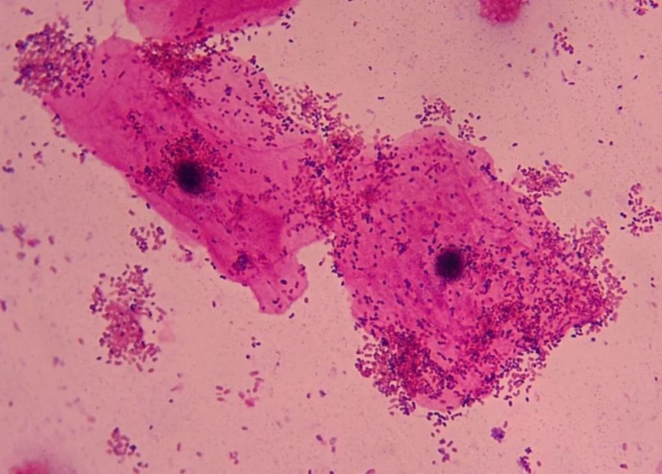白带常规中的「线索细胞」是什么?有何临床意义?-腾讯新闻