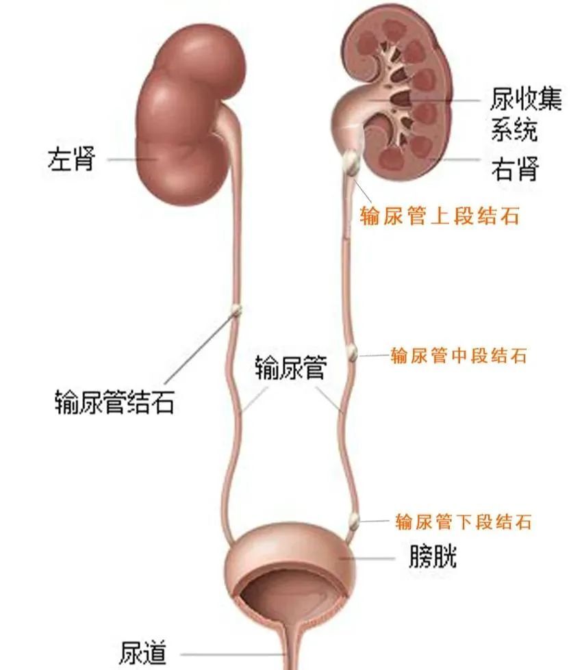 尿路结石包括肾结石,输尿管结石,膀胱结石和尿道结石等,是泌尿外科