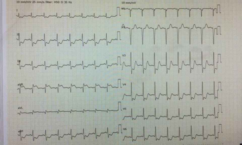 左主干心梗心电图表现图片